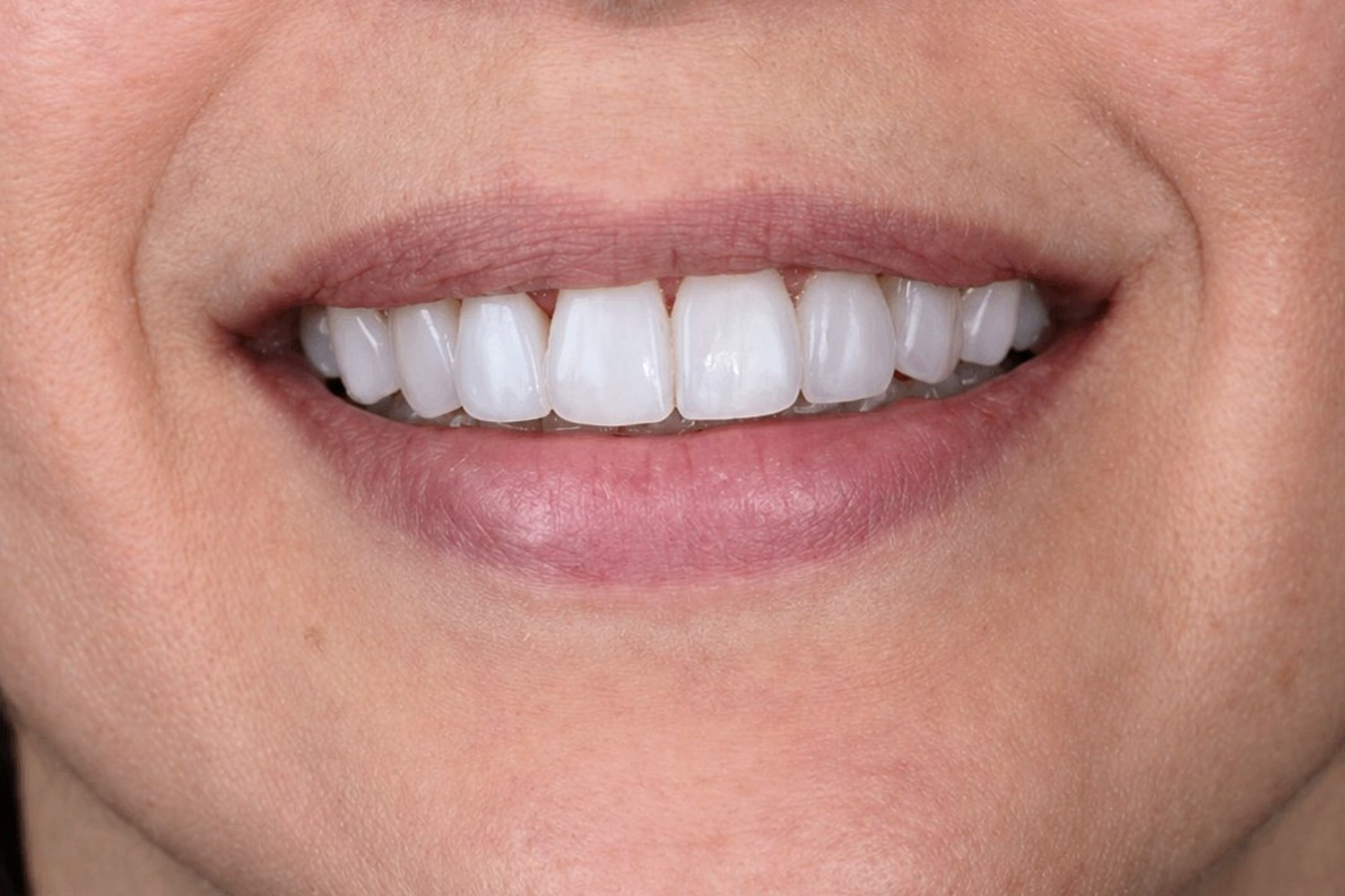 Featured case — after prepless veneers