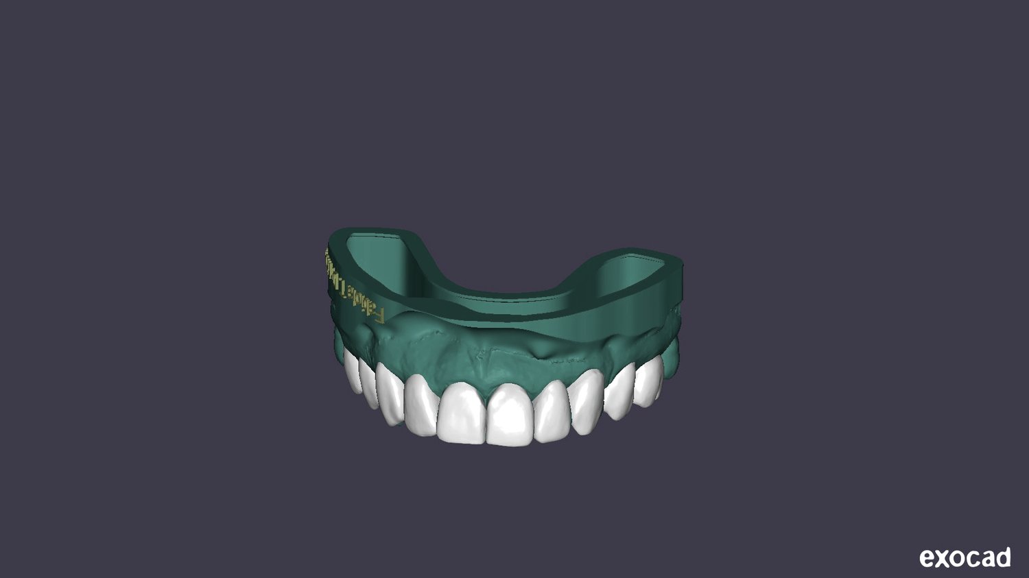 Digital design of veneers in exocad