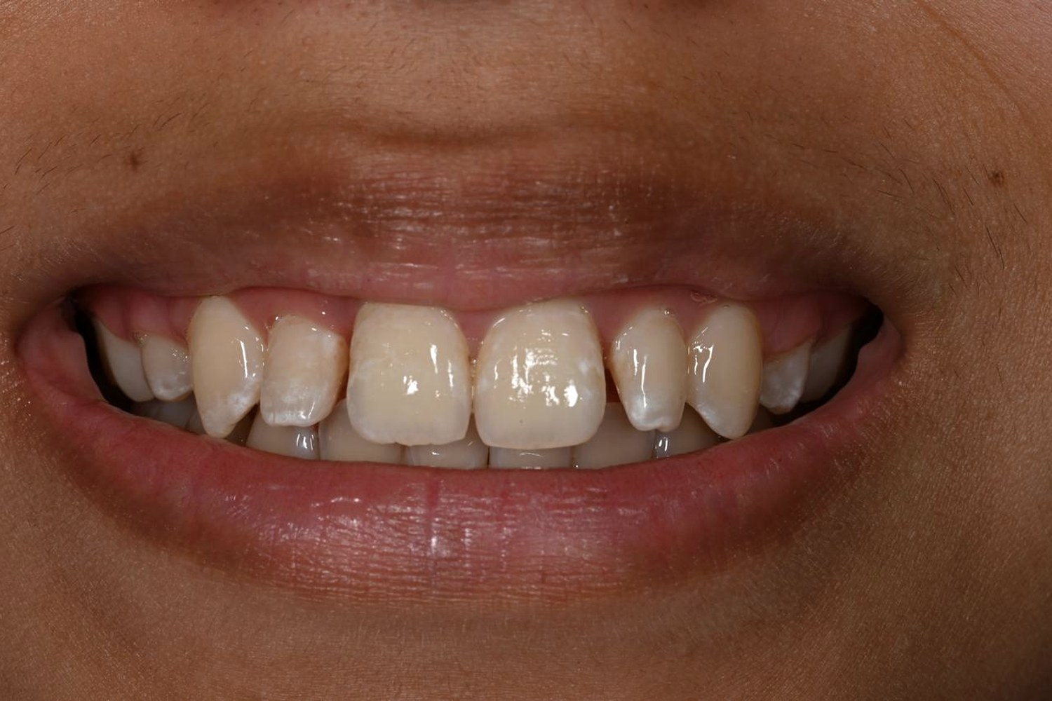 Featured case 02 — before (conoid laterals after orthodontics)