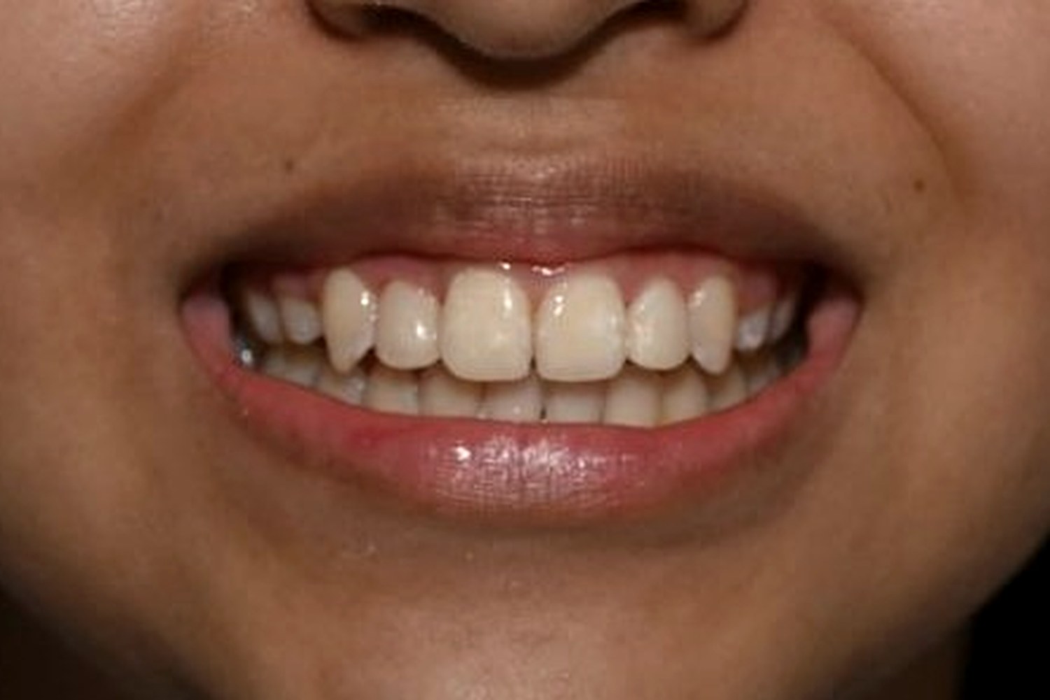 Featured case 02 — after (conservative composite restoration)