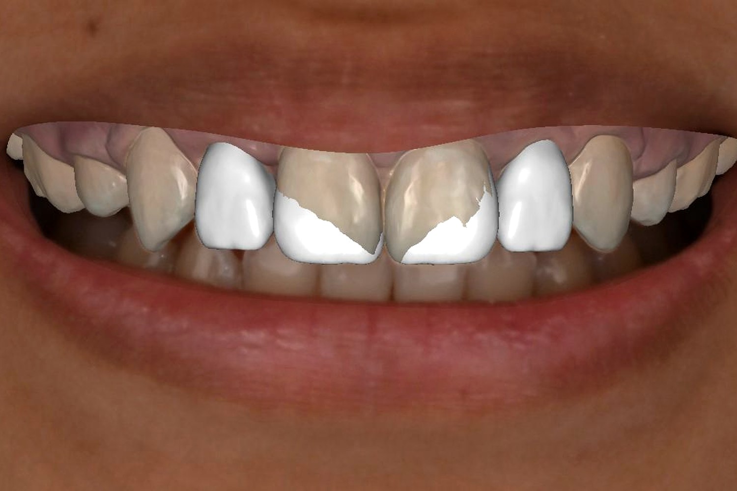 Digital design overlay on patient's smile