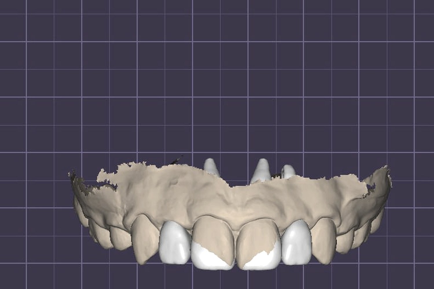 3D digital model of conservative restoration plan