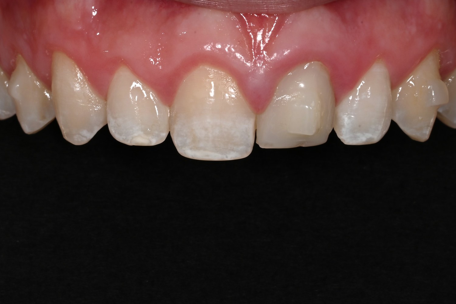 Featured case 03 — before (trauma + fluorosis)