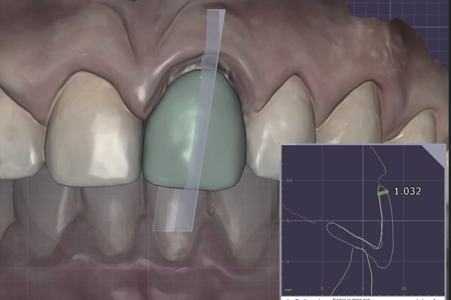 Digital mirroring of the contralateral tooth