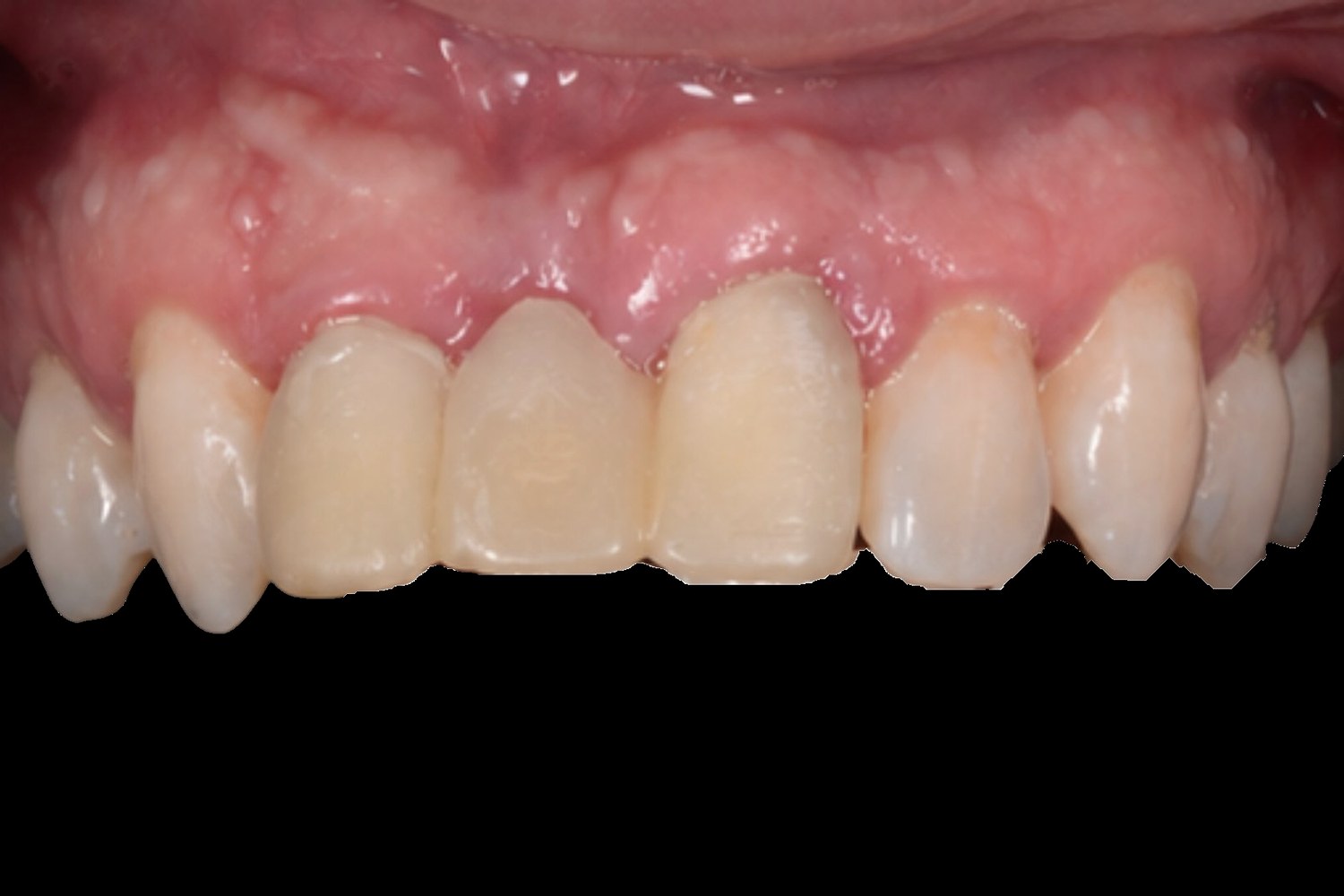 Veneers case 01 — before