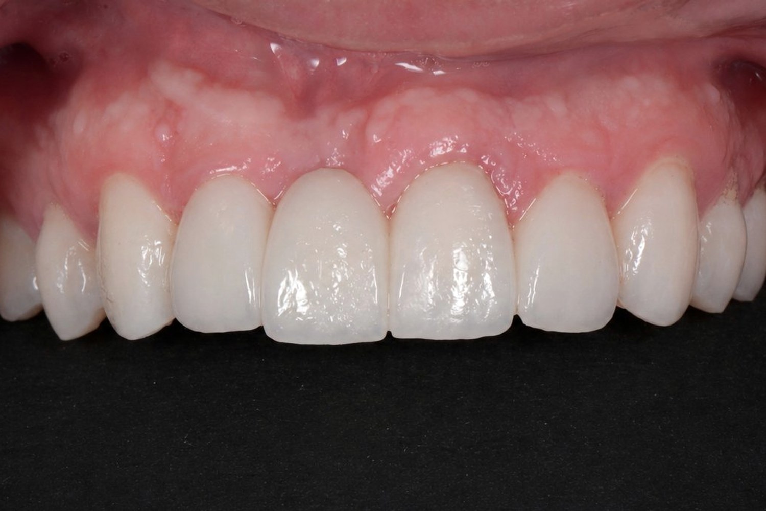 Veneers case 01 — after