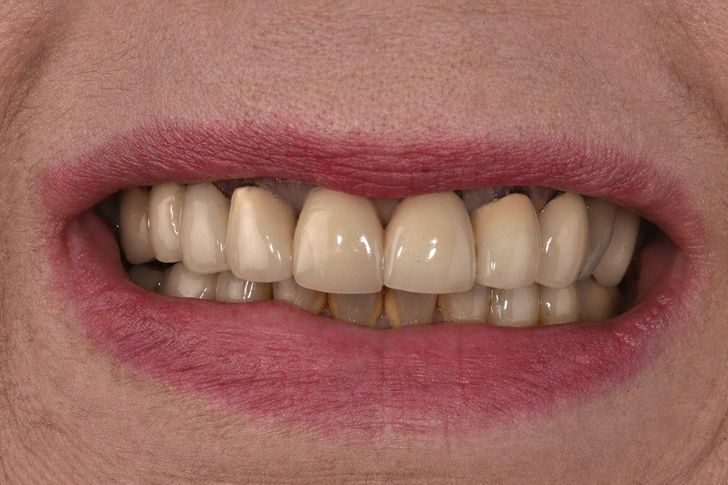 Veneers case 02 — before (old PFM crowns)