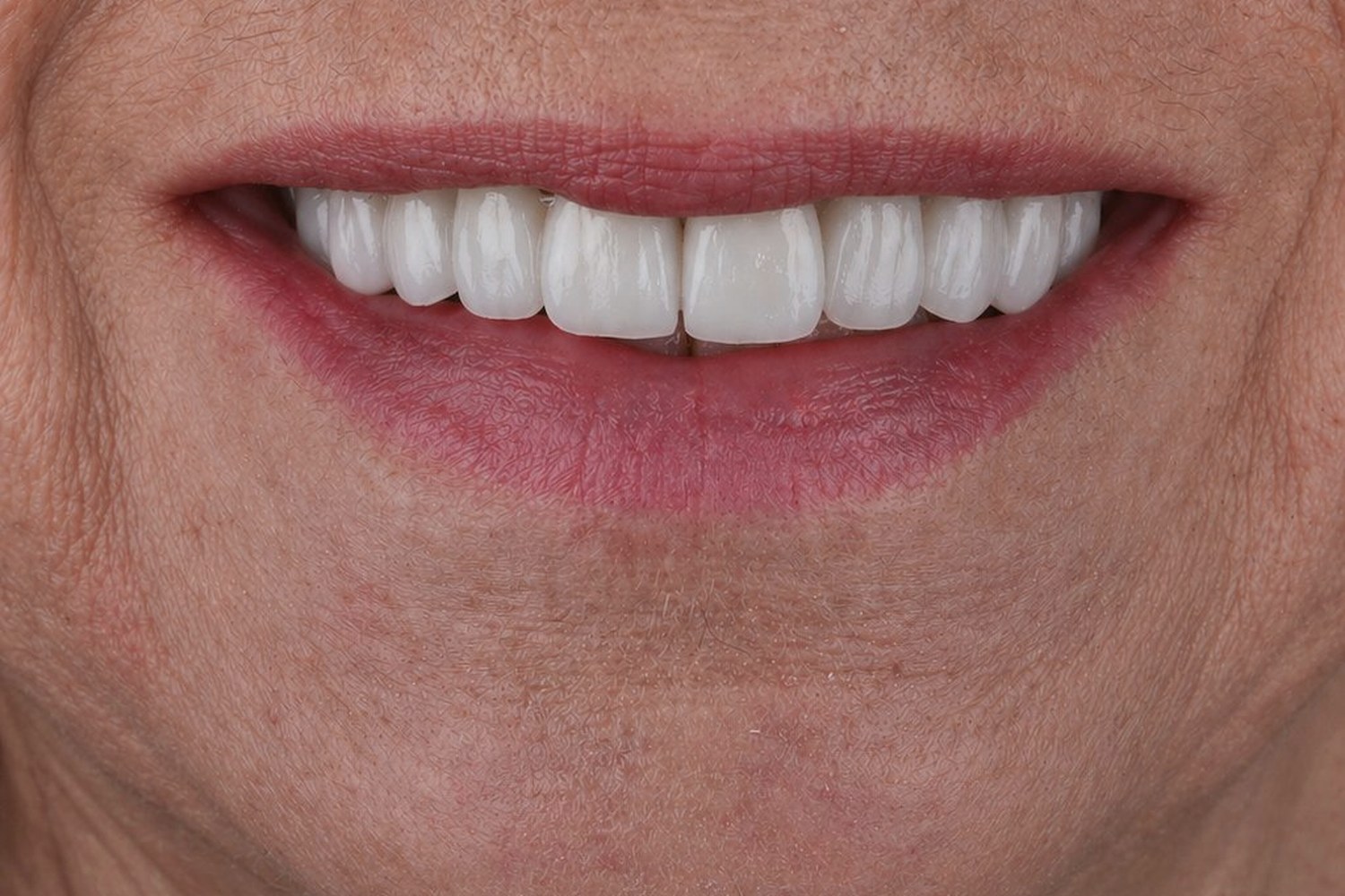 Veneers case 02 — after (porcelain veneers)